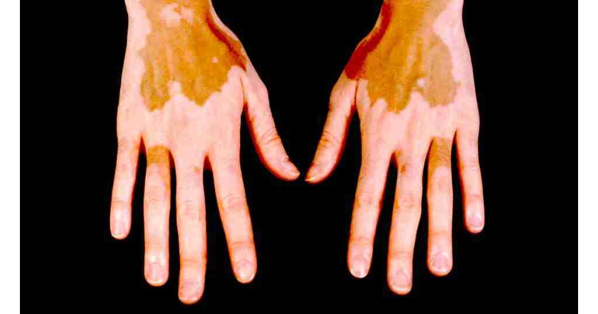 Addison Hastalığı Nedir? Nedenleri, Belirtileri ve Tedavisi