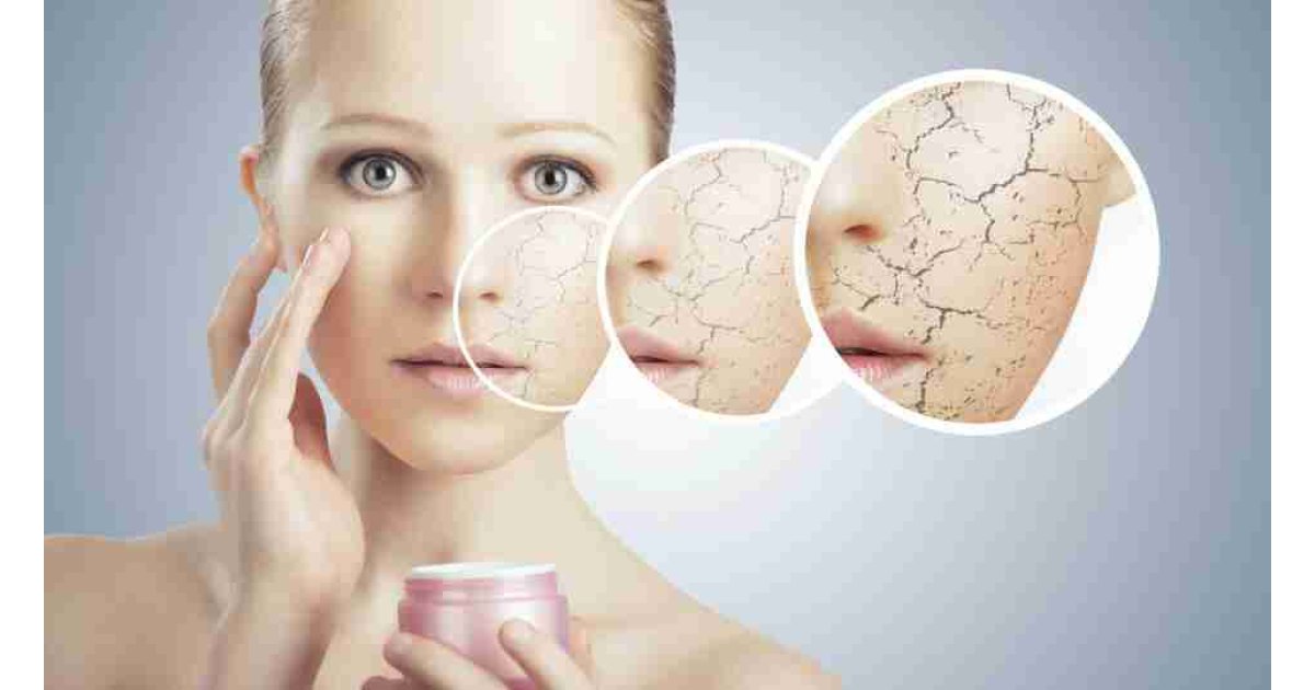 Cilt kuruluğu neden olur, nasıl geçer? Cilt kuruluğuna ne iyi gelir?