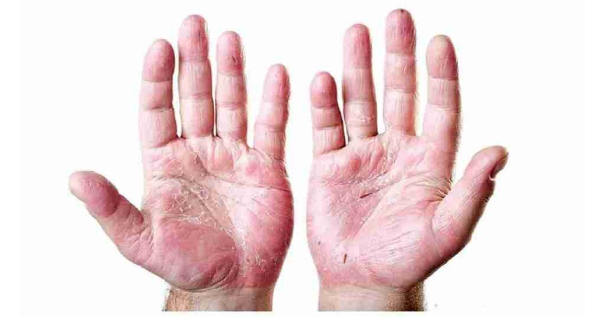 Egzama neden olur, nasıl geçer, egzamaya ne iyi gelir?