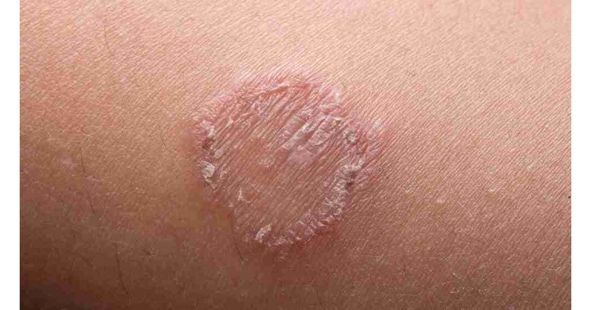 Mantar neden olur, nasıl geçer, nasıl tedavi edilir?