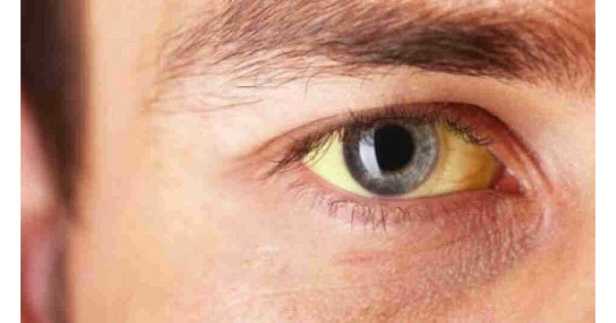 Sarılık nedir? Sarılık belirtileri nelerdir? Sarılığa iyi gelecek 5 yiyecek!