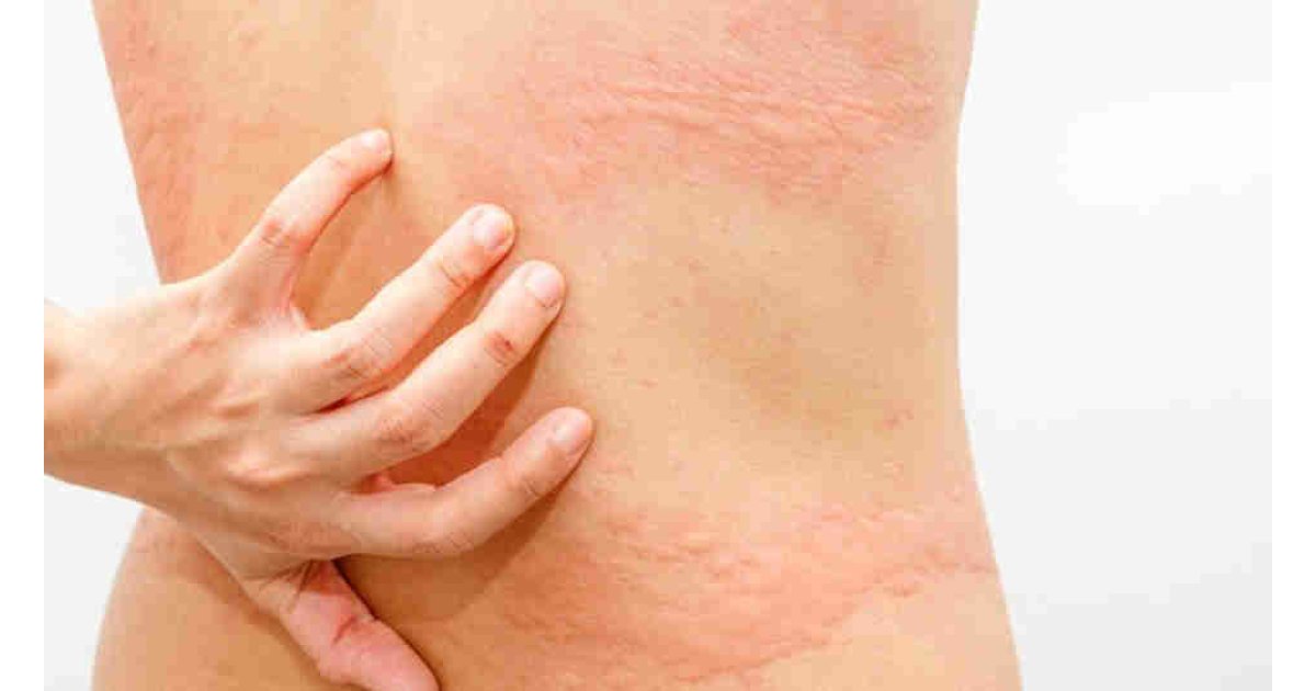 Vücutta kaşıntı neden olur? Vücutta kaşıntı ve kızarıklık nasıl geçer? Kaşıntıya ne iyi gelir?