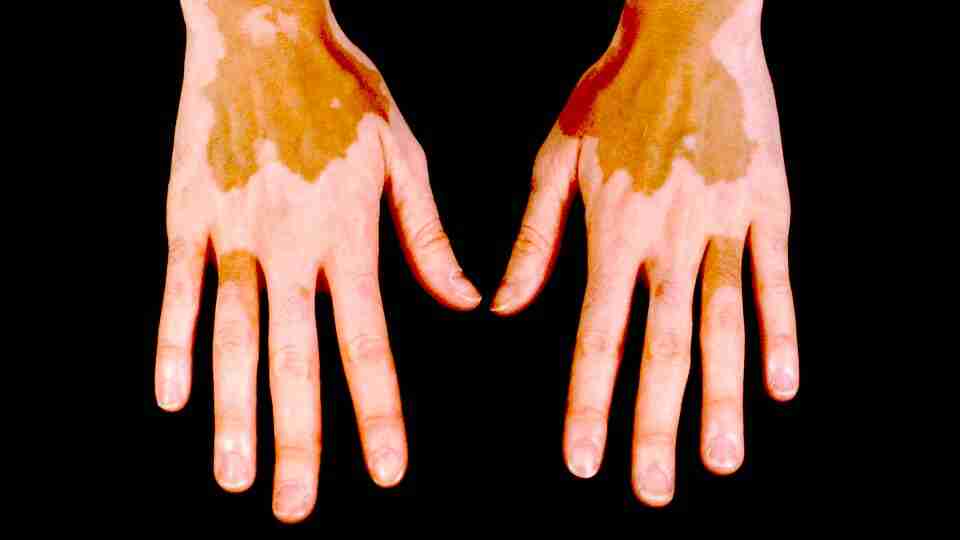 Addison Hastalığı Nedir? Nedenleri, Belirtileri ve Tedavisi