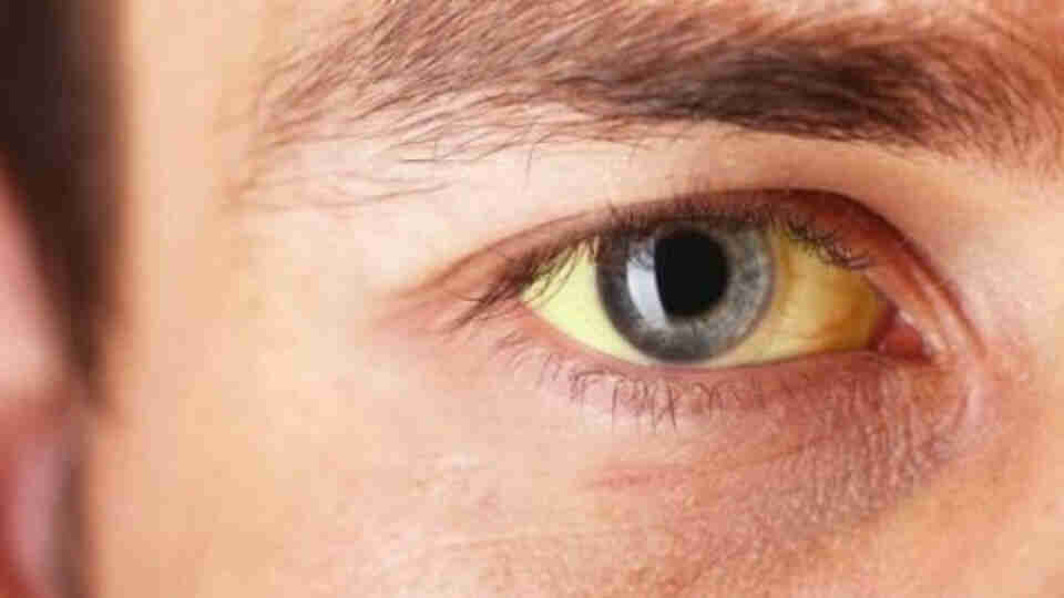 Sarılık nedir? Sarılık belirtileri nelerdir? Sarılığa iyi gelecek 5 yiyecek!