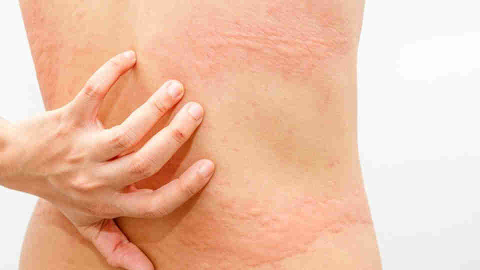 Vücutta kaşıntı neden olur? Vücutta kaşıntı ve kızarıklık nasıl geçer? Kaşıntıya ne iyi gelir?
